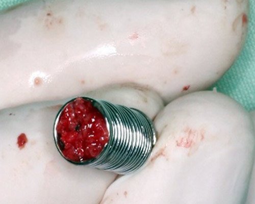 Kostne rekonstrukcie – stomatolog MUDr. Kucera Jan Kosice