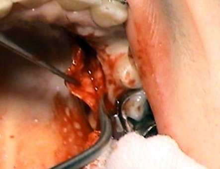 Aplikacia stepov – parodontologia Kosice – Stonek s.r.o_