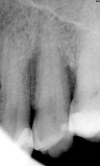 Parodontologia – rontgeny – Stonek sluzby v Kosiciach