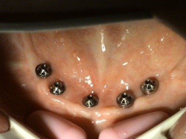 Stonek implantologia, protetika - Kucera Jan