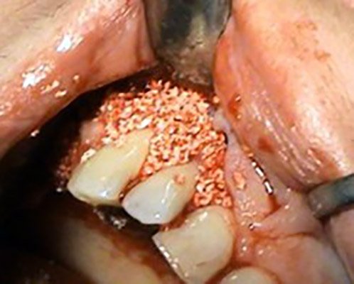 Augmentacia – dentoalvolarna chirurgia Kosice – Stonek – MUDr. Kucera Jan