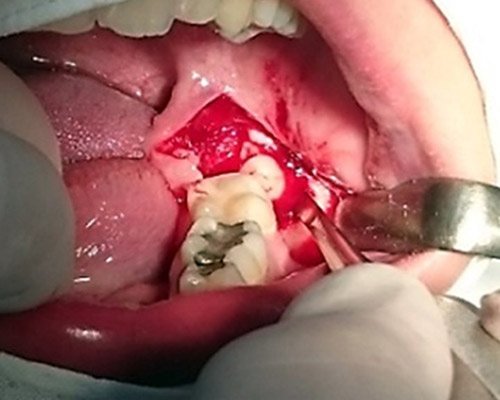 Mukogingivalne operacie – Stonek Kosice Kriva 23