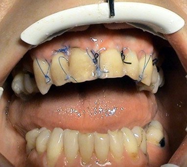 Korekcie recesov – Stonek zubny lekar Kosice – MUDr. Kucera Jan