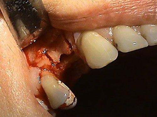 Stonek – Implantologicke nahrady