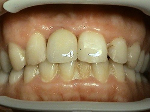 Proteticke riesenie implantologie - Stonek