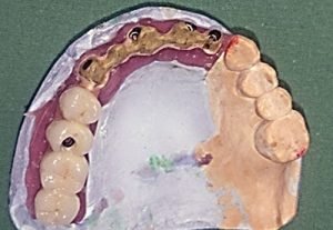 Protetické riešenia - implantologia Stonek Kosice