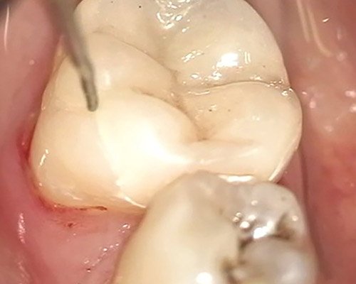 Liecba korenovych kanalikov – Stonek, MUDr. Kucera Kosice