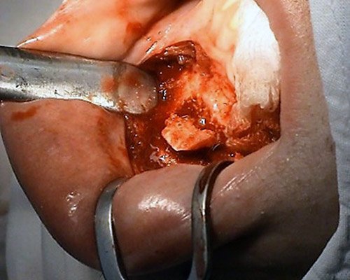 Mukogingivalne operacie – MUDr. Kucera Jan – zubar Kosice