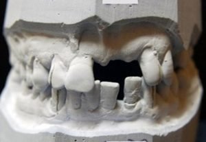 Frontálny defekt v čeľusti - implantologia Kosice - MUDr. Kucera Jan