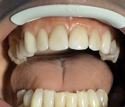 Korekcie recesov – Stonek – zubar Kosice – MUDr. Kucera Jan