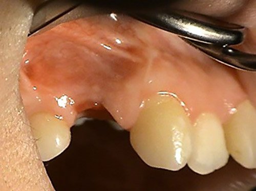 Nahrady chybajucich zubov – Stonek