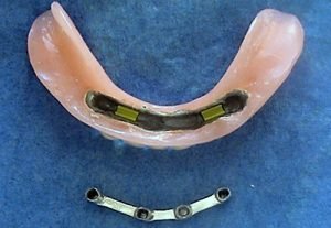 Bikortikalne implantaty - zubar MUDr. Kucera Jan PhD. Košice