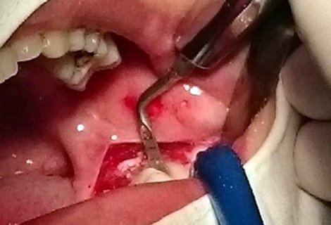 Kvalitné ošetrenie pomocou piezochirurgie v Stonek ambulancii