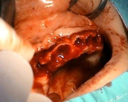 Zákroky dentoalveolárnej chirurgie – Stonek Kosice Kriva 23