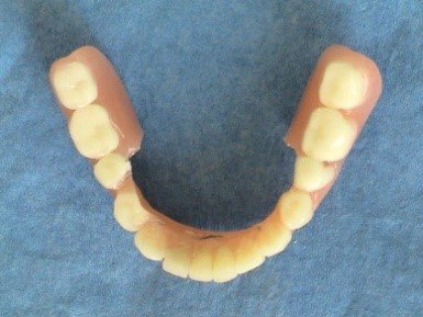 Okamzita implantacia a protetika - all in one - implantolog Kucera Jan - Kosice