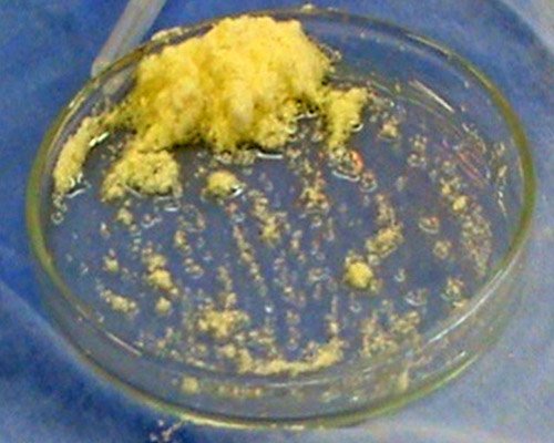 Dentoalveolarna chirurgia – vyuzitie autologneho dentinu – Stonek