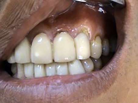 Korekcie recesov – parodontologia Stonek Kosice