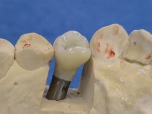 Nahrady chybajucich zubov – Stonek Kriva 23