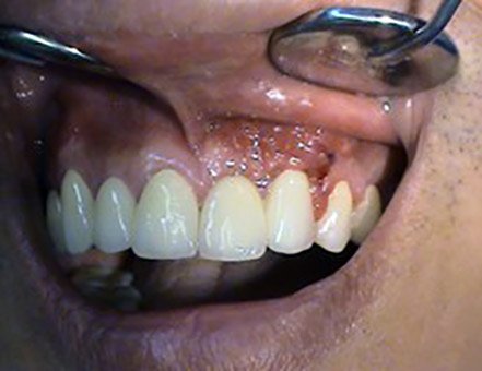 Korekcie recesov – parodontologia Stonek Kosice Kriva 23