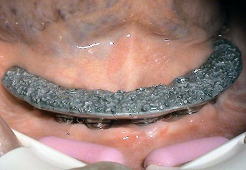 Stonek - implantologia MUDr. Kucera Jan Kosice