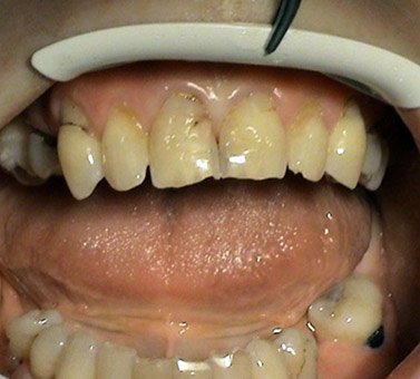 Korekcie recesov – Stonek zubna ambulancia Kosice