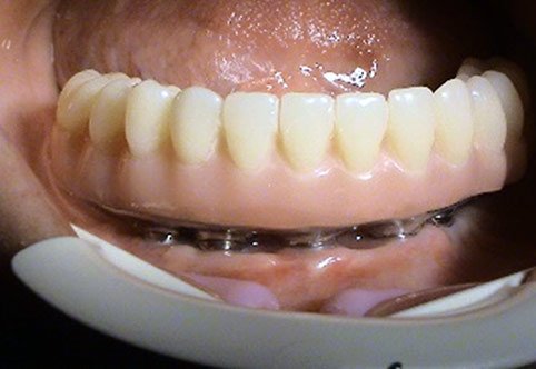 Implantologia Stonek Kosice, Kriva 23