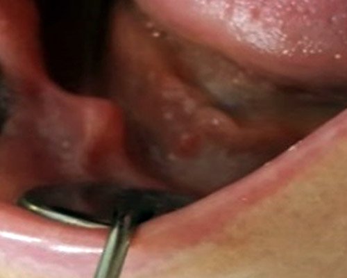 Augmentacie (prosekcne, alveolarnych vybezkov) – Stonek s.r.o_