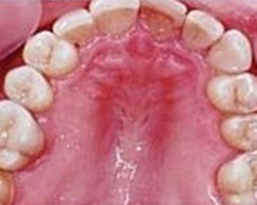 Zubny kaz – zubar Kosice – Stonek s.r.o. – Kucera Jan