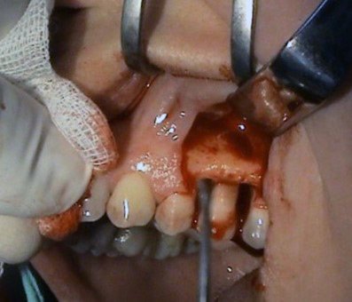 Riadena kostna regeneracia – Stonek – MUDr. Kucera Jan