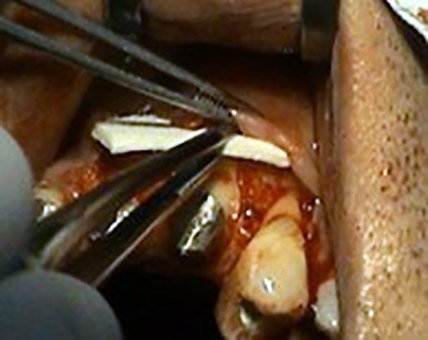 Aplikacia stepov – parodontologia Kosice – Stonek – MUDr. Kucera Jan