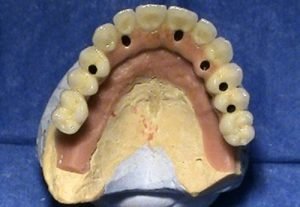 Implantologia zubnej ambulancie Stonek v Kosiciach