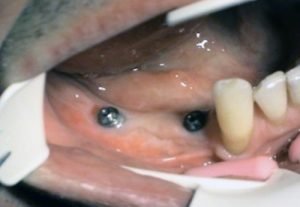 Implantacia zadných bezzubých úsekov v sánke - Stonek Kosice