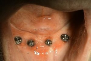 Liečba bezzubej sánky - 4 implantáty - STONEK Košice