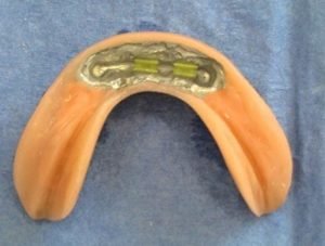 Liečba bezzubej sánky - stomatologia Stonek - MUDr. Kucera Jan