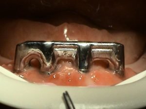 Strmeňova konštrukcia - stomatologia Stonek Košice